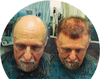 hair-loss-soluction